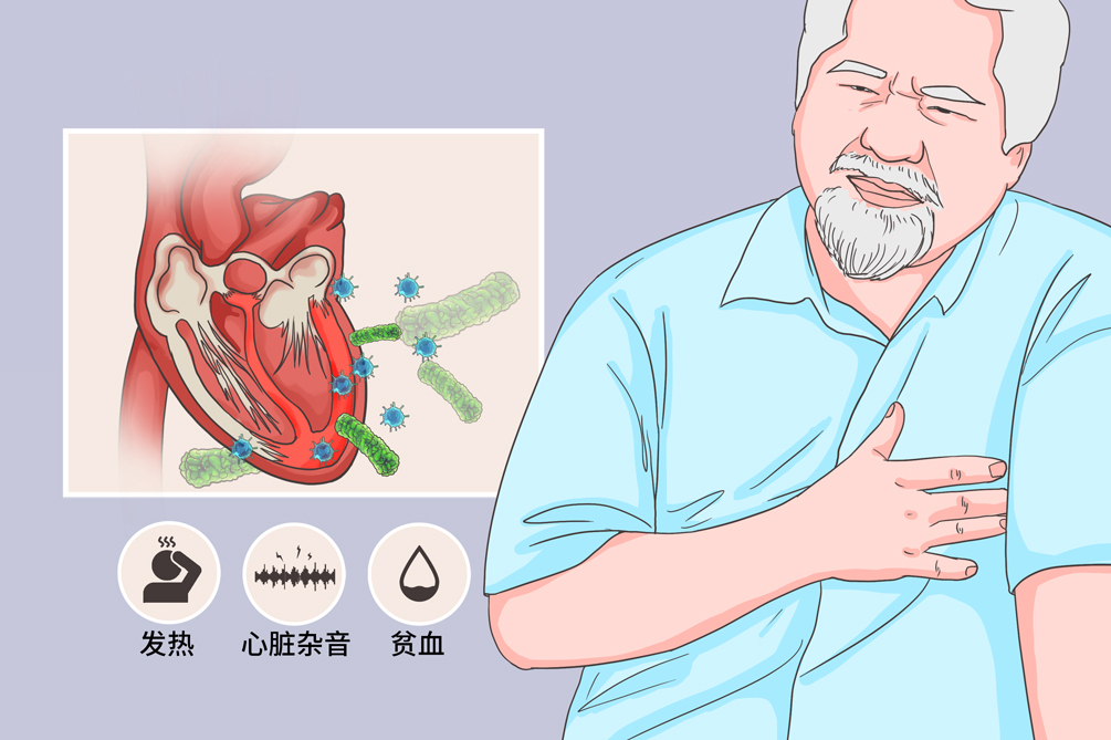 急性感染性心内膜炎