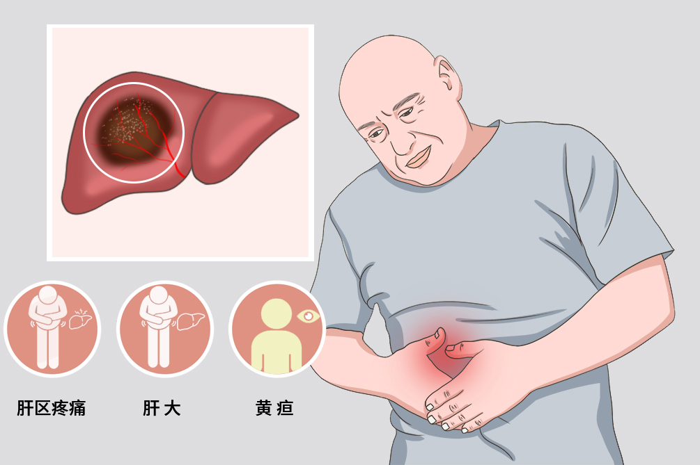 继发性肝癌