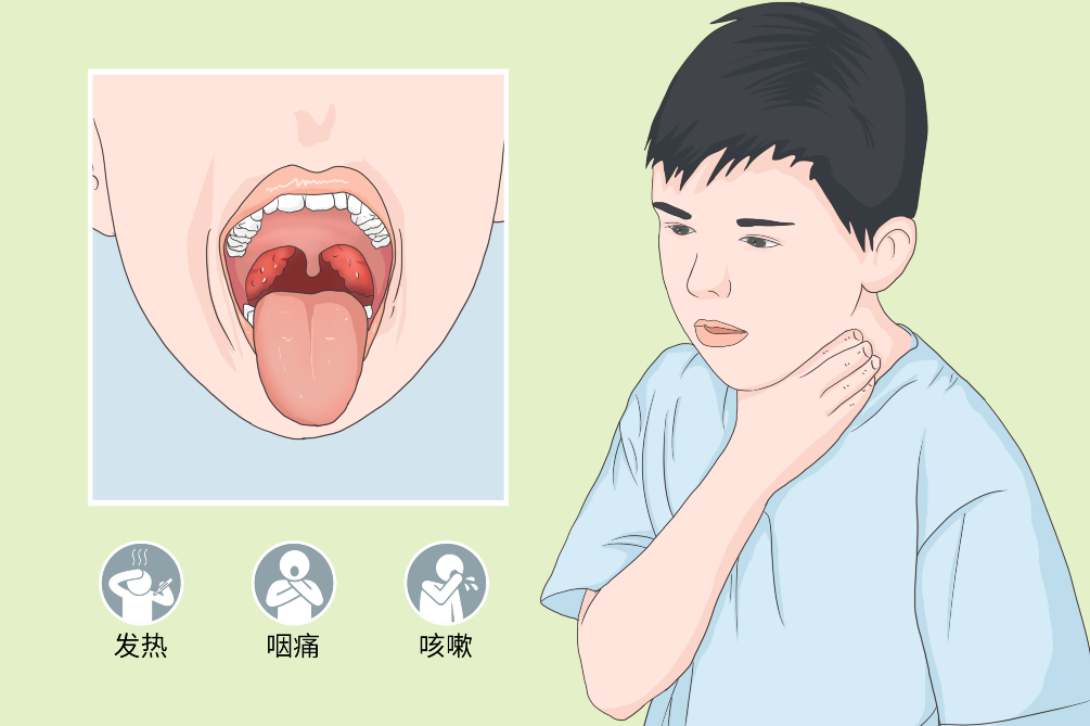 小儿疱疹性咽峡炎