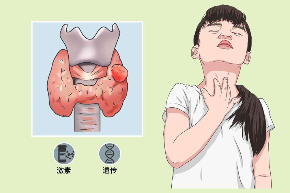 甲状腺乳头状癌