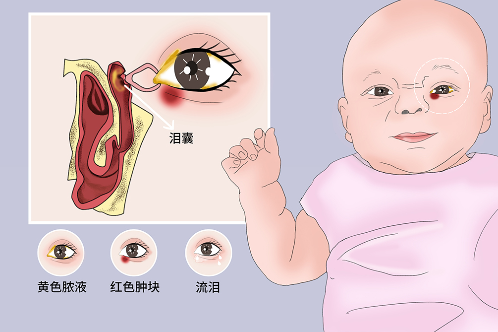 新生儿泪囊炎