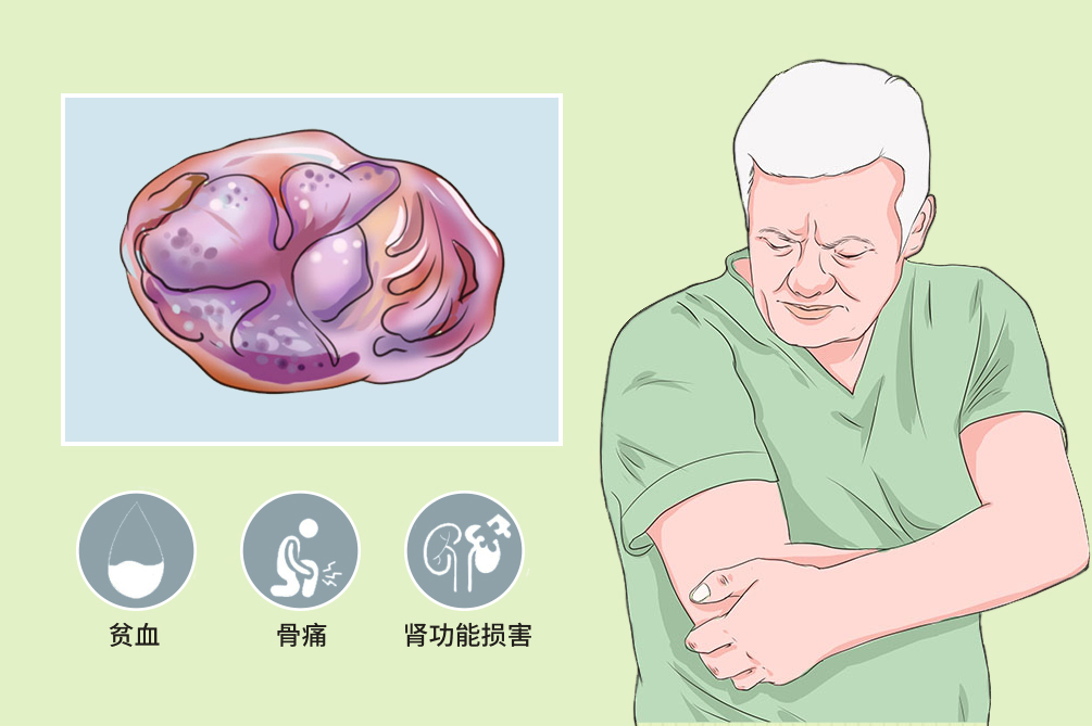 多发性骨髓瘤