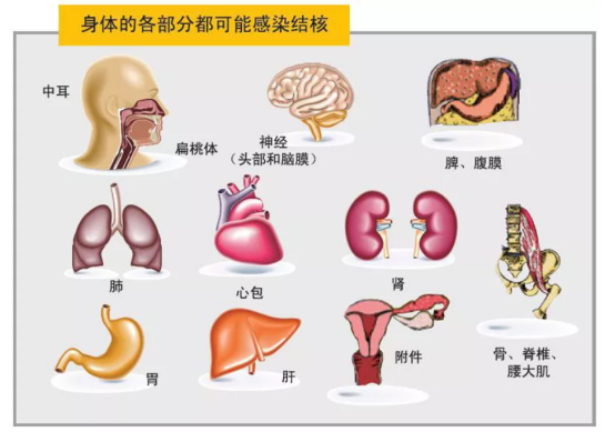 肺结核算重大疾病吗