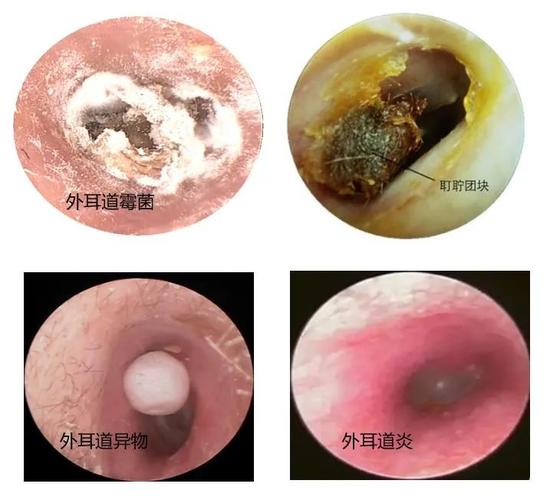 得了急性外耳道炎如何掏耳朵