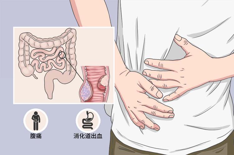 肠梗阻的发病原因和高发人群