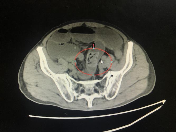 检查ct结果为肠梗阻不除外