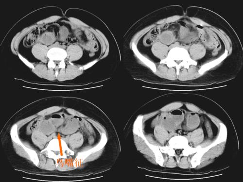 检查ct结果为肠梗阻不除外