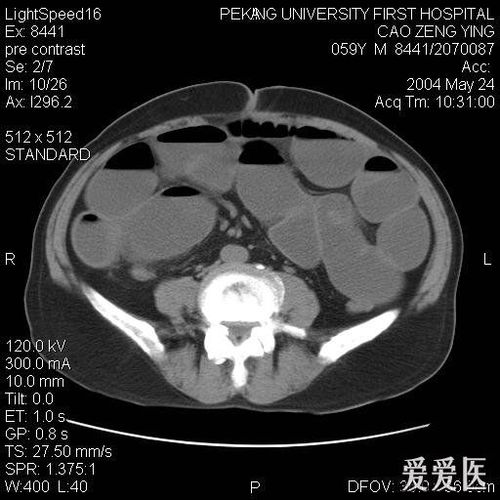 检查ct结果为肠梗阻不除外