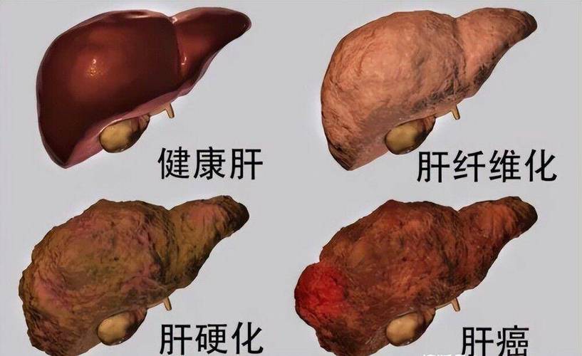 中期肝硬化可以逆转到早期吗