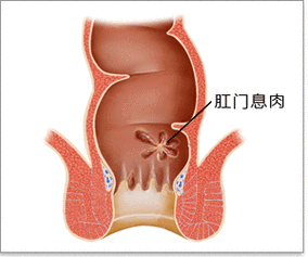 肛门上有坨肉就是肛门息肉吗