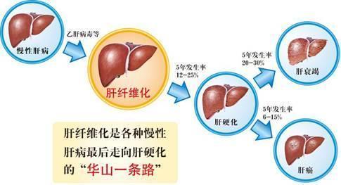 肝硬化晚期能治好吗