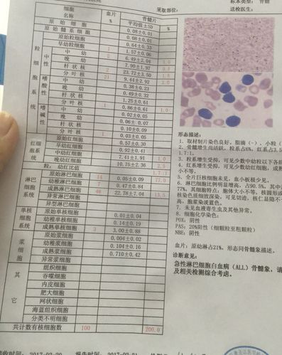 急性淋巴细胞白血病能治好吗