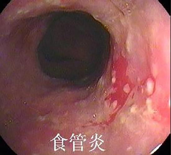 化脓性食管炎严重吗怎么治疗