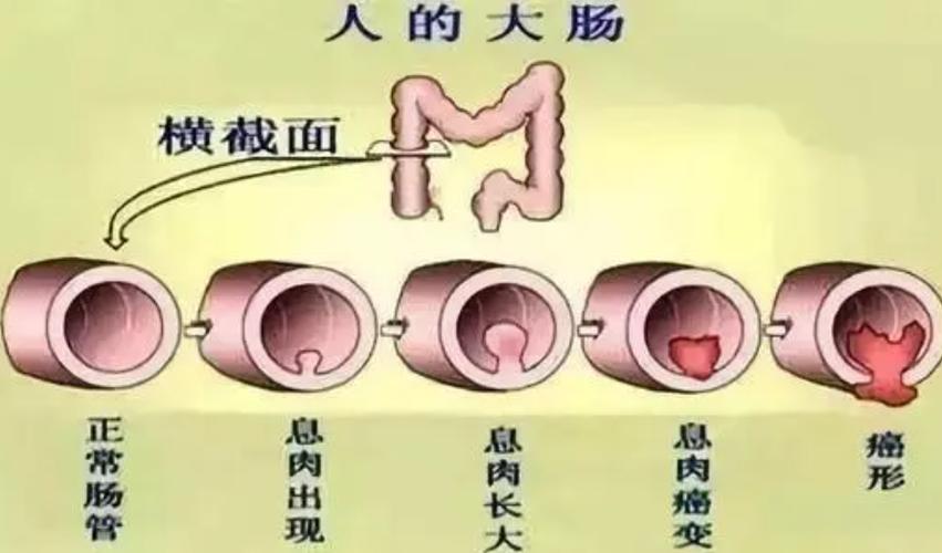 肛门上有坨肉就是肛门息肉吗