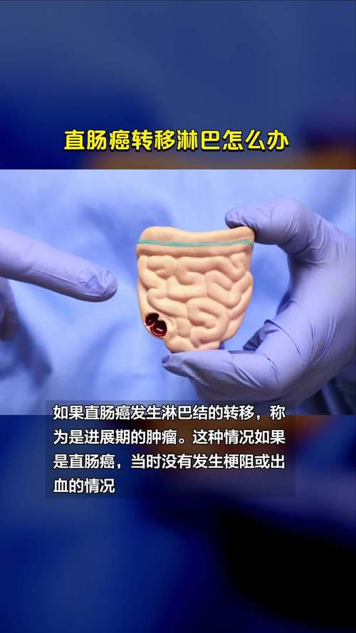 结肠癌淋巴结转移化疗有用吗