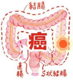 结肠癌与结肠良性肿瘤的区别