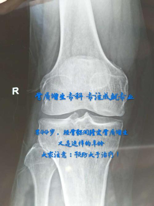 骨质增生白细包增多