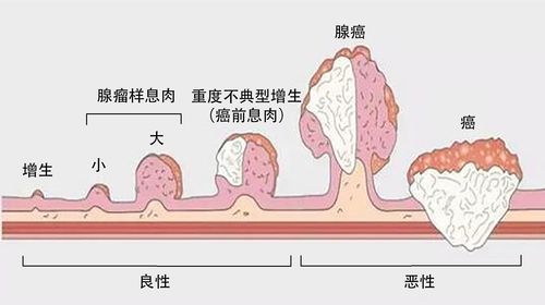 结肠癌与结肠良性肿瘤的区别