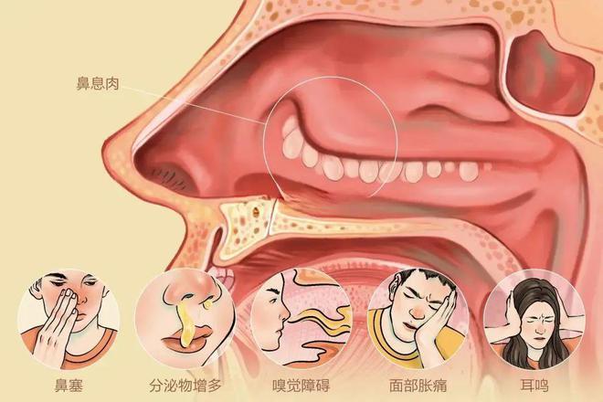 鼻炎引起的中耳炎怎么治疗