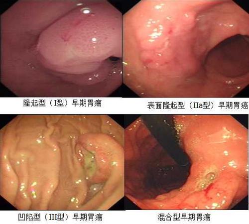 胃癌晚期转移到肝会不会传染