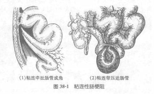 胃癌手术后会引起肠粘连吗