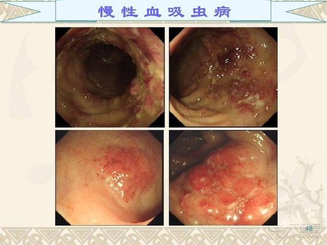 大便痢疾是什么症状引起的呢