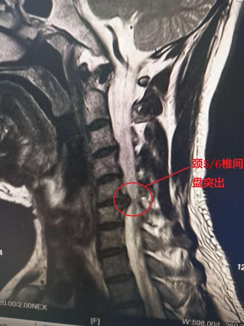 颈椎间盘突出但不疼痛却头晕