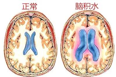 小朋友脑积水会引发癫痫吗