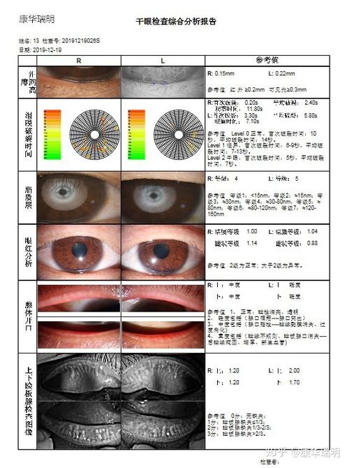 眼科怎样检查是不是干眼症