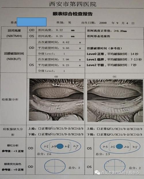 眼科怎样检查是不是干眼症