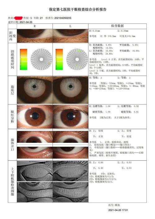 眼科怎样检查是不是干眼症