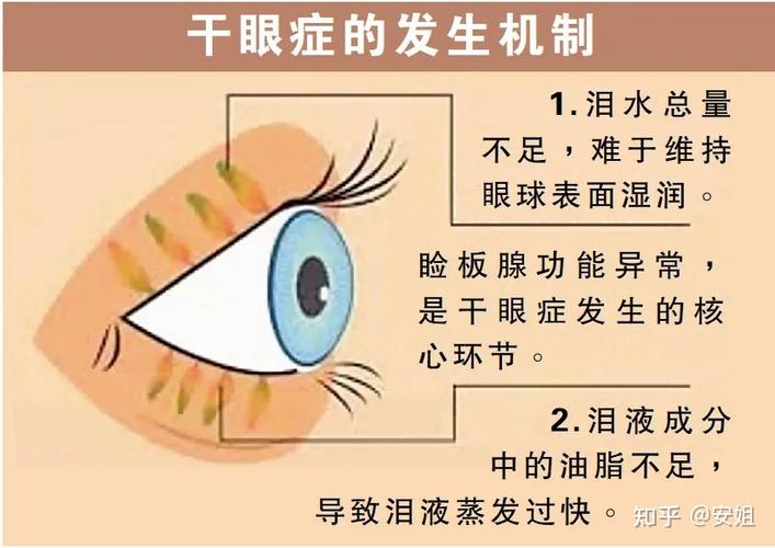 怎样判断自己是否是干眼症