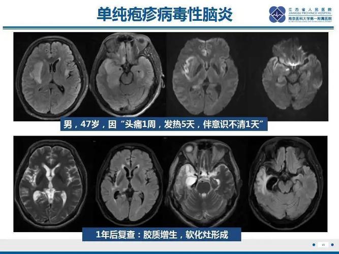 病毒性脑炎反复发作怎么办