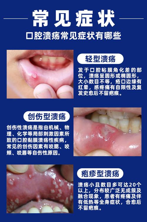 口腔溃疡病因 嘴里长的溃疡