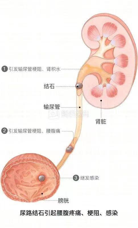 尿结石和肾结石的区别在哪里