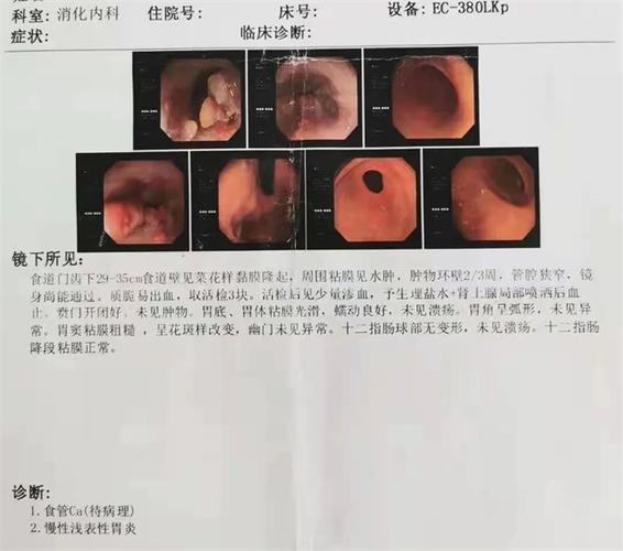 62岁今天检查出食道癌早期