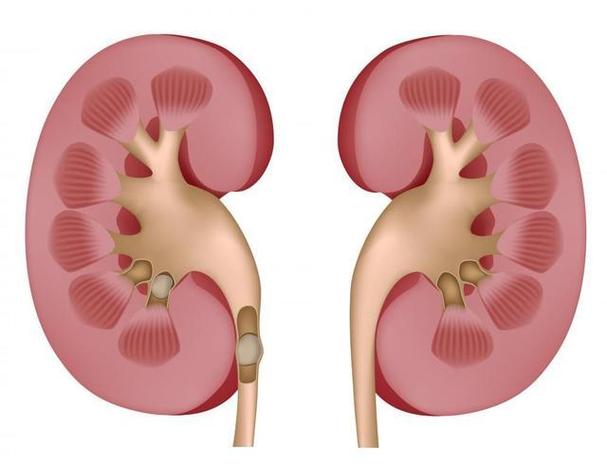 尿结石和肾结石的区别在哪里