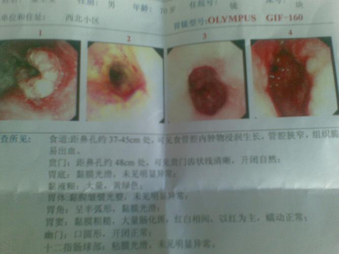 62岁今天检查出食道癌早期