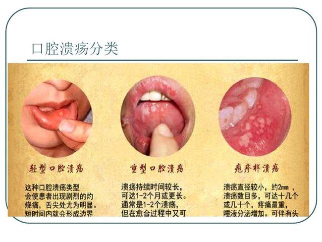 口腔溃疡病因 嘴里长的溃疡