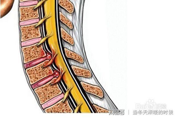 颈椎骨刺增生c3