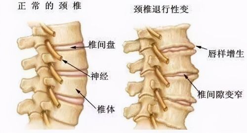 颈椎骨刺增生c3