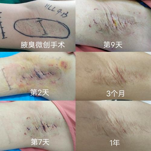 腋下狐臭疤痕褶皱怎么去除