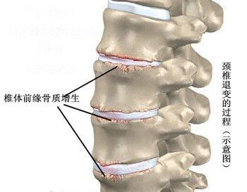 骨质增生包括骨刺吗