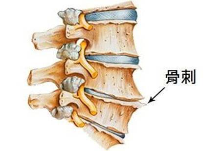 骨质退行性变是骨质增生吗