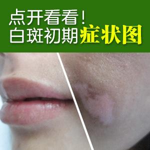 怎么治疗白癜风才能治好呢