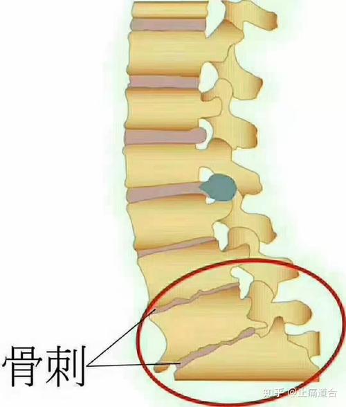 骨质增生包括骨刺吗