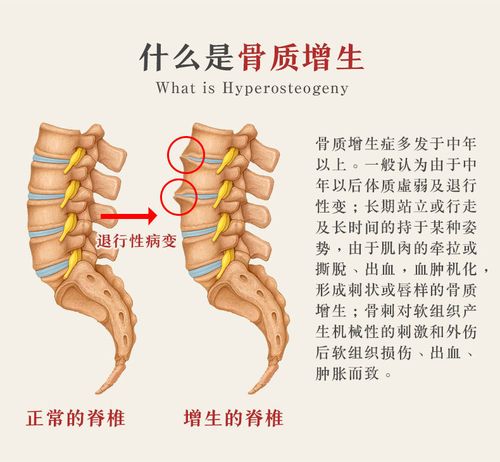 骨质退行性变是骨质增生吗