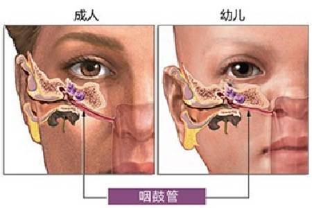 如何判断孩子是否得了中耳炎