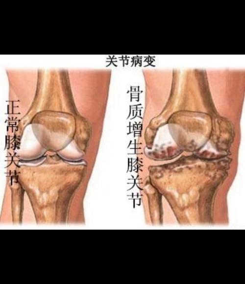 骨质增生包块自己会消退吗