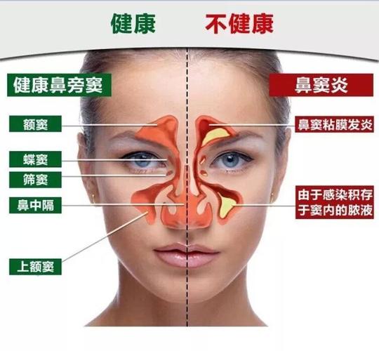 鼻窦炎嗜酸粒细胞高